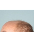 Before Hair Transplant&nbsp;2 Sessions (Areas)